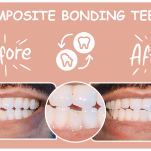 Sculpting Smiles: The Subtle Art of Personalised Composite Bonding